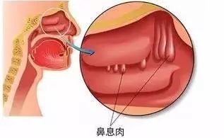 鼻息肉最新研究及治疗进展综述